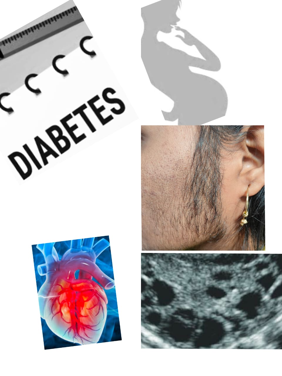 PCOS